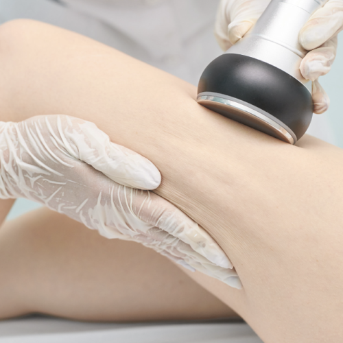 radio frequency treatment illustration